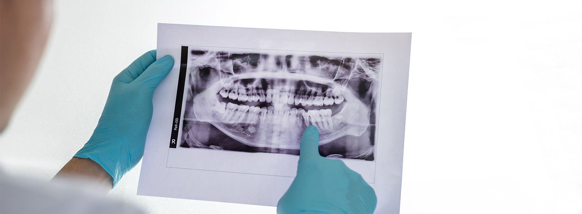 A person wearing blue gloves is holding a large dental X-ray, which shows a detailed view of teeth and gums.