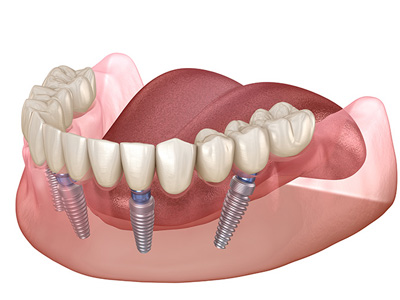 The image shows a set of teeth with visible dental implants and screws, displayed against a white background.