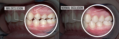 The image shows a side-by-side comparison of a human mouth with teeth in various stages of decay and discoloration, illustrating the progression from normal to severe dental issues.